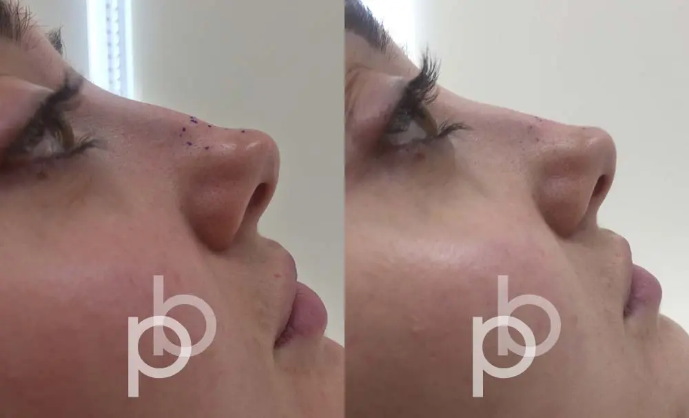 Paul Banwell non surgical rhinoplasty 130619