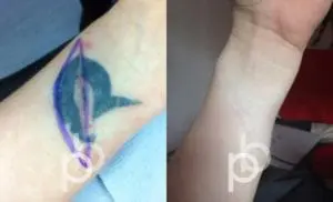 Paul Banwell tattoo removal-140619-1