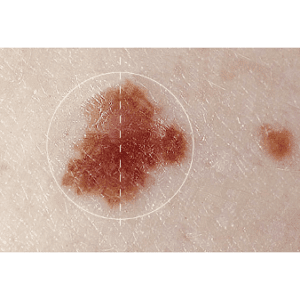 Asymetric mole