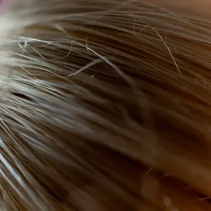 Bringing Confidence Forward: A Personal Look at Hairline Lowering Surgery
