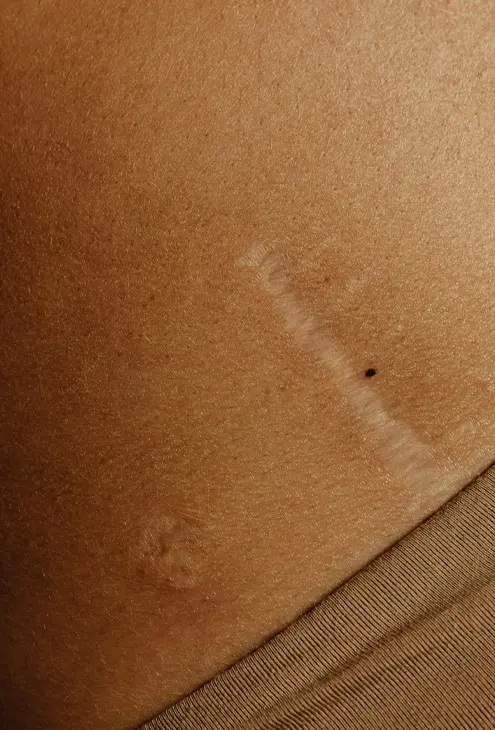 Paul Banwell - Scar Revision Overview