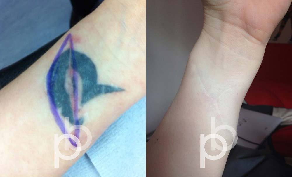 Tattoo Removal London - Stunning Results - Paul Banwell