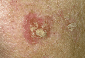 Actinic keratosis