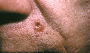 Basal Cell Carcinoma