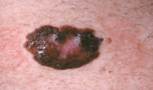 Melanoma