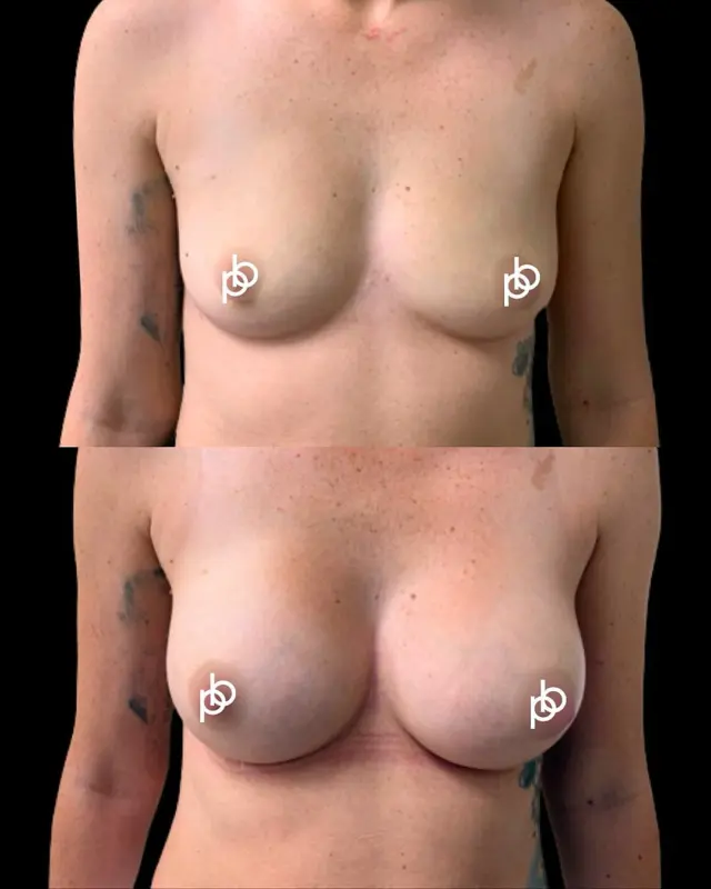 One size never fits all 🤌🏼 🔥 

Results achieved using 285cc Motiva implants, chosen specifically for this patient’s anatomy and desired outcome.

The right implant isn’t simply about volume - it’s about creating balance, proportion and a result that feels right for you 🖤 

🔗 If you’re considering breast augmentation, save this post for future reference or leave your questions below 👇🏽 We’d love to answer them.