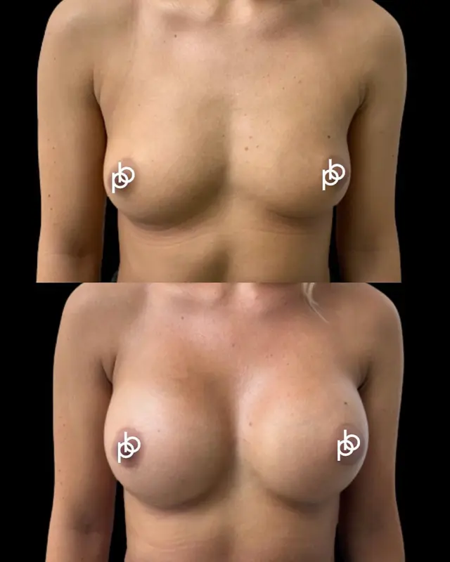 Beautifully balanced, naturally proportioned results using @motivaimplants 

This patient underwent breast augmentation using 265cc Motiva implants, carefully selected to complement her frame and achieve a soft, refined enhancement.

Implant choice is never based on volume alone. Width, projection, existing breast tissue and the patient’s individual goals all play an important role in creating a result that feels harmonious and personal.

Considering breast augmentation? Save this post for future reference or leave your questions below. 🤍