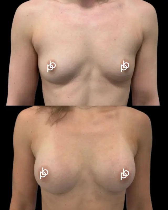 The beauty of breast augmentation can be in just how natural the result appears 🖤 

This result was achieved using Motiva Preservé®, with the implant selected specifically to complement the patient’s anatomy and desired outcome.

Choosing the right implant is about far more than volume alone. Width, projection, proportion and existing breast tissue all play an important role in creating a balanced result that feels entirely personal to you. 🖤

🔗 Considering breast augmentation? Save this post for future reference or leave your questions below.