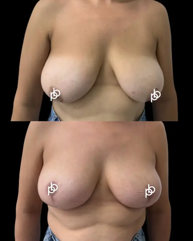Sometimes regaining confidence is about restoring what was once yours. 🖤

A mastopexy, also known as a breast uplift, is designed to reshape and lift the breasts by addressing sagging and restoring a more youthful position and contour. Unlike a breast augmentation, it doesn’t necessarily increase breast size - it focuses on improving shape and proportion.

Every procedure is carefully tailored to the individual, taking into account their anatomy, lifestyle and desired outcome 

For many patients, the biggest transformation isn’t just what they see in the mirror - it’s how they feel when they look at themselves again.

🔗 If you’re considering a breast uplift, save this post for future reference or leave your questions below 👇🏽