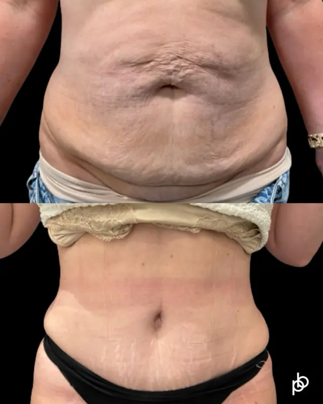 What if feeling more like yourself started with feeling comfortable in your body again? 🖤

For some patients, changes to the abdomen following pregnancy, significant weight change or simply time can leave excess skin and changes that lifestyle alone cannot address.

While the physical transformation can be significant, for many patients it’s the renewed confidence that means the most.

Considering a tummy tuck? Comment below or send us a private message to find out more 👇🏽