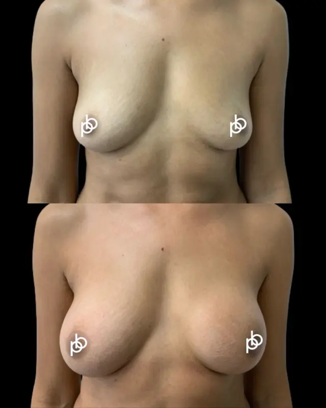 Correcting asymmetry isn’t always about using the same implant sizing🖤 @miafemtech 

Different implant sizes - 170cc and 195cc, were selected by the patient to work with her individual anatomy, creating a beautifully balanced result while maintaining soft, natural looking proportions.

Because the goal isn’t to make every breast identical. It’s to understand the anatomy you’re starting with and plan according to a patient’s wishes. Mia Femtech was her preferred technique and she is delighted with the outcome 

💌 Considering @miafemtech ? Send us a private message to find out more or visit paulebanwell.com