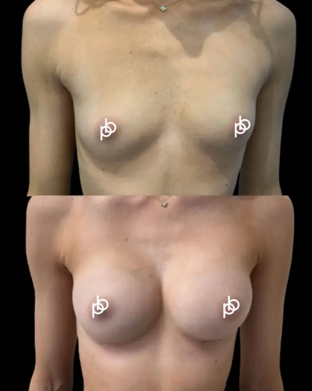 A beautiful example of Dr. Paul’s signature Ballerina Breast 🩰 🖤 

Designed for patients seeking a subtle enhancement that complements, rather than dramatically changes, their natural proportions.

For this patient, Dr Paul used the @motiva_uk Preservé technique to create a petite, refined result - introducing gentle shape and volume while working in harmony with her individual anatomy.

Subtle, considered and beautifully proportioned ✨ 

Save this for your breast augmentation inspiration, or send us a private message or leave a comment below to find out more about Ballerina Breast👇🏽