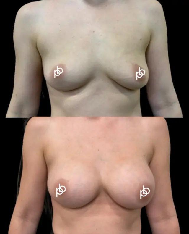 Not every breast augmentation is about creating the ‘perfect’ breast🖤

For this patient, a mastopexy (breast uplift) was discussed as a possiblle option , but the patient was clear that she did not want to accept the scarring associated with a mastopexy 

Dr. Paul therefore worked within her preferences, using implants alone to add volume and shape while respecting her existing breast anatomy.

It’s a good reminder that the right surgical plan isn’t simply about what could be done - it’s about understanding the individual, their priorities and the result they want to achieve.

Considering surgery? Send us a private message or arrange a consultation via the link in our profile💌