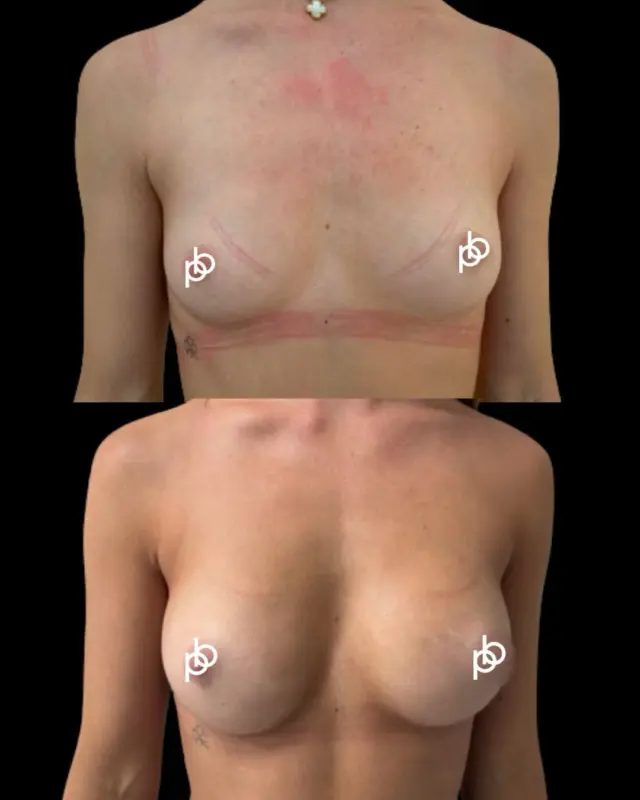 An exquisite Ballerina Breast. Beautifully balanced, with a little more volume🖤

For this patient, Dr. Paul used 220cc Motiva implants, placed over the muscle, to create increased fullness and a more defined breast shape while remaining beautifully proportioned to her frame.

Every detail, from implant size and profile to placement - is carefully considered around anatomy, proportions and personal goals.

Love letter💌 Considering breast augmentation? Send us a private message with your questions or arrange a consultation with. Dr Paul via the link in our profile