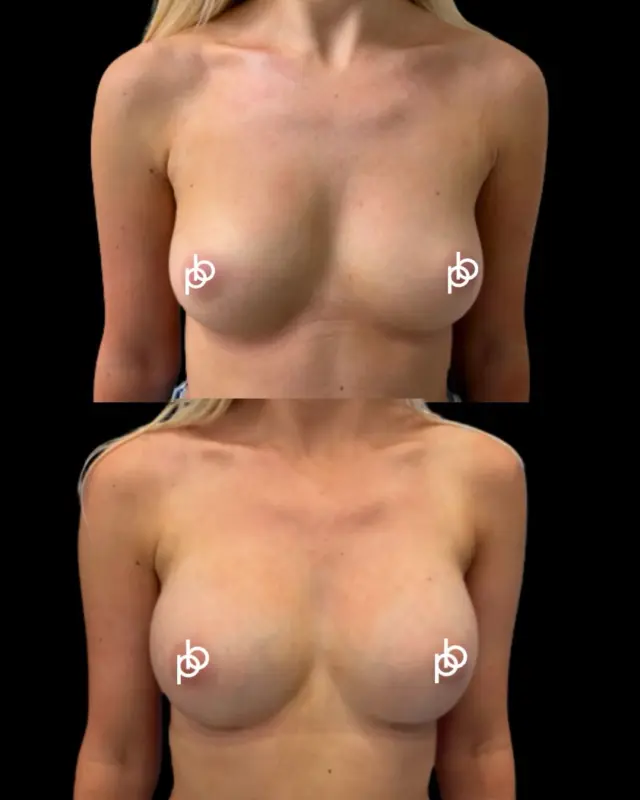 When you already love your breast shape, sometimes it’s simply about adding a little more 🍉 

This patient was already happy with the natural shape, she wasn’t looking for a dramatic change - just a little more volume and fullness through the upper pole.

Using carefully selected implants, Dr. Paul was able to enhance what was already there rather than change it, creating a beautifully understated result that still feels completely in keeping with her natural frame.

🔗 Considering breast augmentation? Send us a private message with your questions, or arrange a consultation with Dr. Paul via the link in our profile. 🖤
