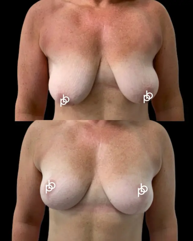 A life changing result for this breast uplift patient 😍🫶🏼

For this patient, a mastopexy was performed to lift and reshape the existing breast tissue, creating a more elevated position, improved contour and a beautifully balanced result.

🔗 Considering a breast uplift with Dr. Paul? Send us a private message with your questions or arrange a consultation via the link in our profile.