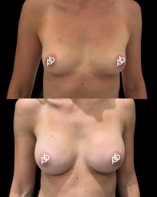 The power of Preservé😍🖤

For this patient, the goal wasn’t to dramatically change her natural shape - it was simply to add a little more volume, enhance what was already there and create a result that still felt completely like her.

Using Motiva Preservé™, Dr. Paul was able to create a beautifully refined enhancement with just enough change to make a real difference to how she feels.

Sometimes, confidence comes from the smallest changes🖤

Interested in booking a no obligation consultation with Dr. Paul? Book via the link in our bio or ask us a question below 👇🏽